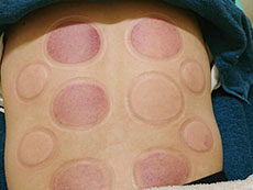 姫路市延末 すずらん接骨院 吸玉（カッピング）療法