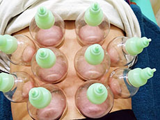 姫路市延末 すずらん接骨院 吸玉（カッピング）療法