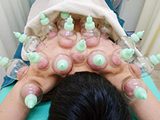 姫路市延末 すずらん接骨院 吸玉（カッピング）療法