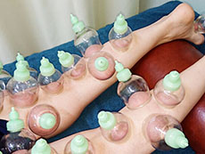 姫路市延末 すずらん接骨院 吸玉（カッピング）療法